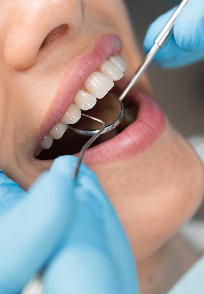 closeup of a patient's smile during their cosmetic dentistry appointment at North Atlanta Family Dentistry