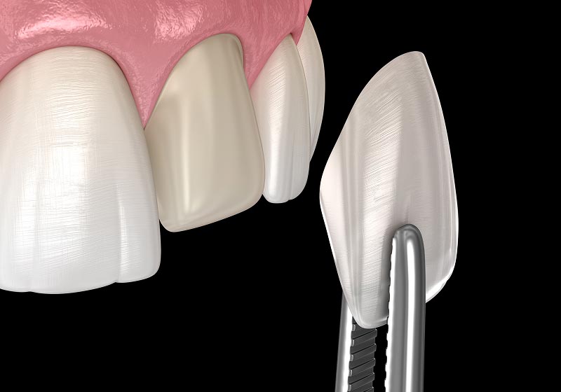 Porcelain veneer being placed on front tooth